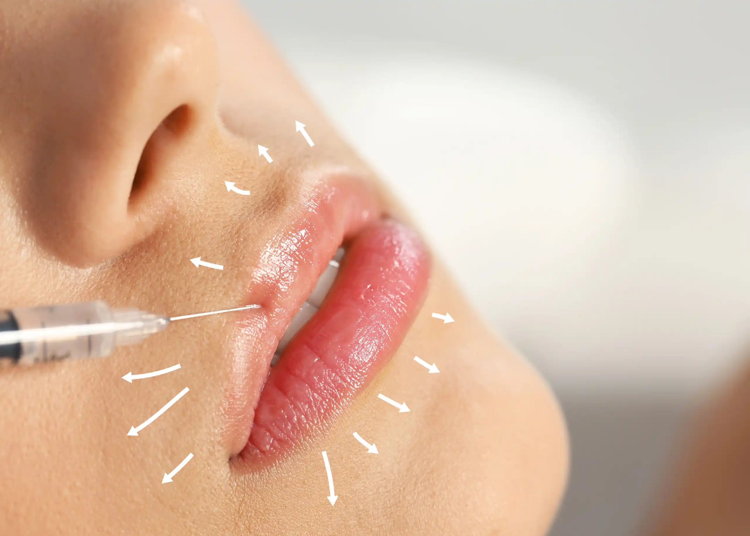 Aplicação de preenchimento labial com ácido hialurônico na MBel